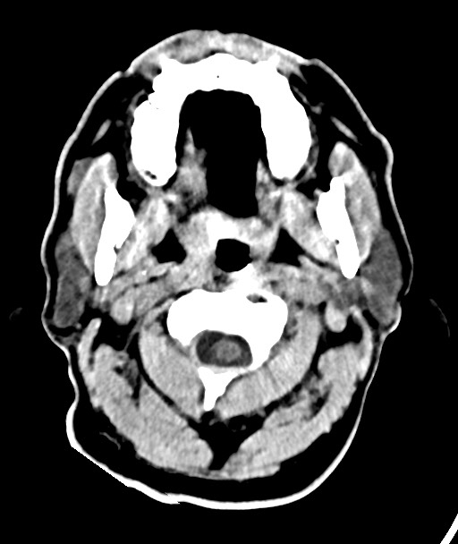 Acute on chronic subdural hematoma (Radiopaedia 78346-90966 Axial non-contrast 6).jpg