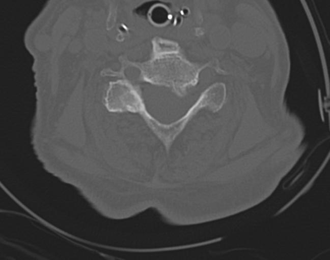 Acute on chronic subdural hematoma and thoracic vertebral injury in a multitrauma patient (Radiopaedia 31698-32619 Axial bone window 36).jpg