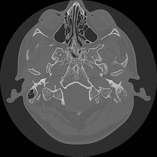 Acute otomastoiditis and Bezold abscess (Radiopaedia 88184-104786 Axial bone window 16).jpg