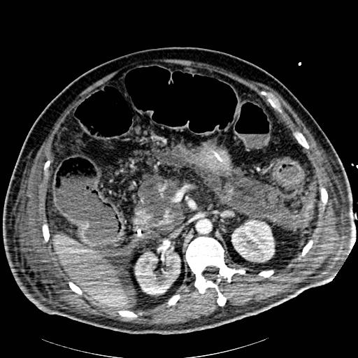 Acute pancreatic necrosis (Radiopaedia 13560-18502 Axial C+ portal venous phase 31).jpg