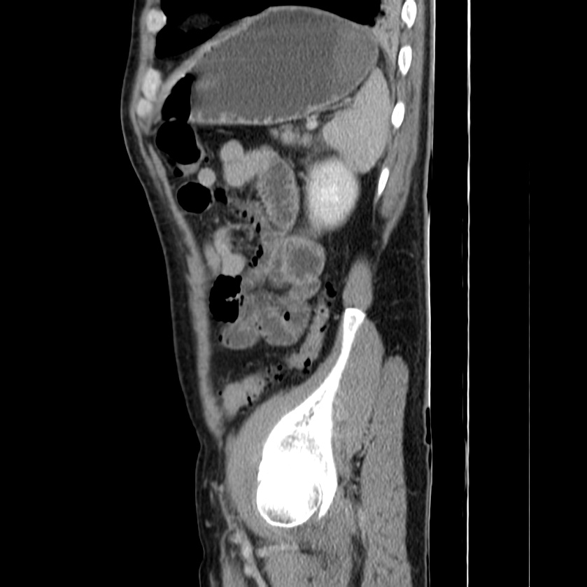 Acute pancreatitis (Radiopaedia 22572-22596 Sagittal C+ portal venous phase 43).jpg