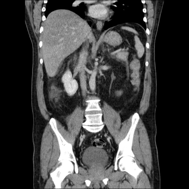 Acute pancreatitis (Radiopaedia 26663-26813 Coronal C+ portal venous phase 38).jpg