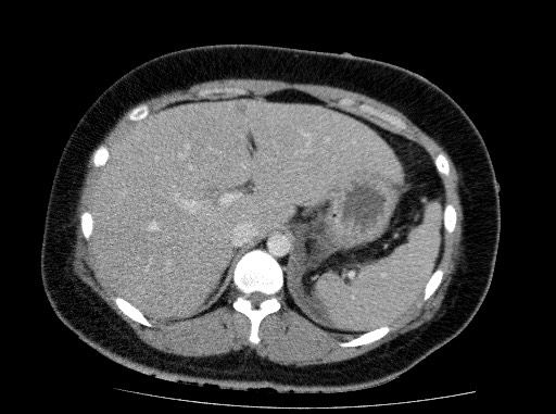 Acute pancreatitis (Radiopaedia 69236-79012 Axial C+ portal venous phase 23).jpg