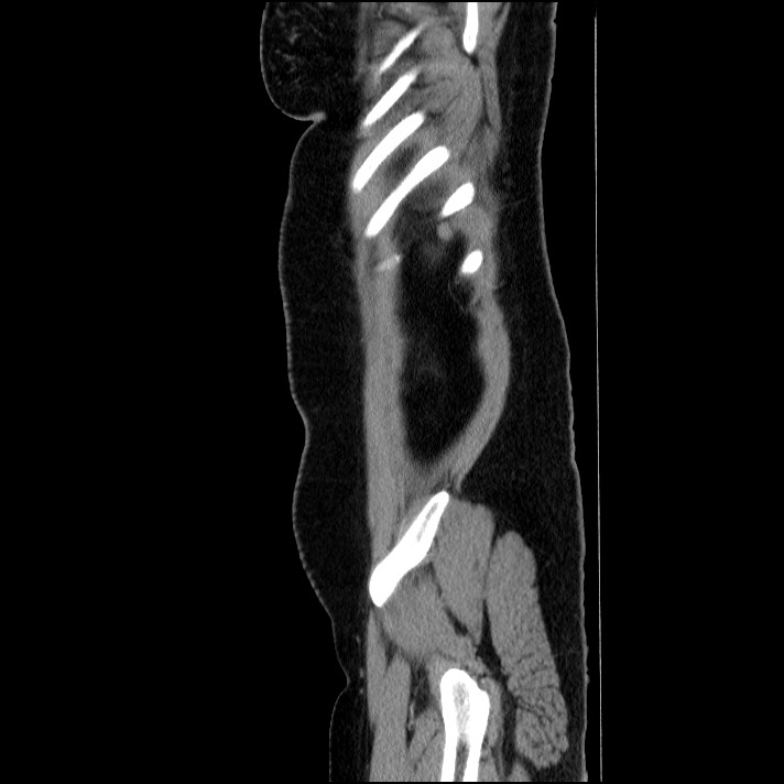 Acute pancreatitis (Radiopaedia 69236-79012 Sagittal C+ portal venous phase 20).jpg