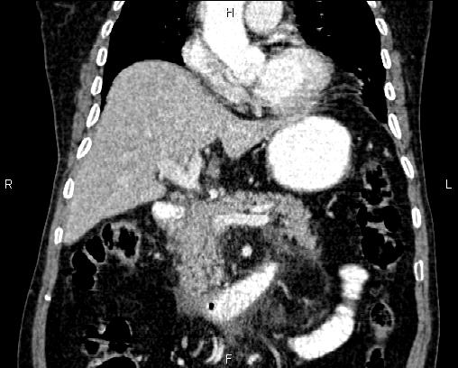 Acute pancreatitis (Radiopaedia 85146-100701 Coronal C+ portal venous phase 33).jpg