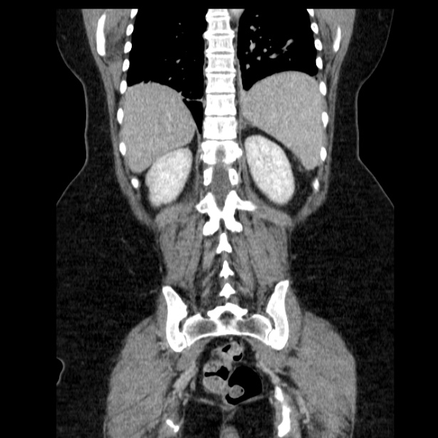 Acute pancreatitis - Balthazar C (Radiopaedia 26569-26714 Coronal C+ portal venous phase 52).jpg