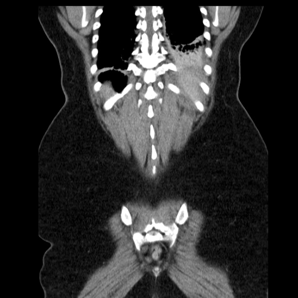 Acute pancreatitis - Balthazar C (Radiopaedia 26569-26714 Coronal C+ portal venous phase 59).jpg