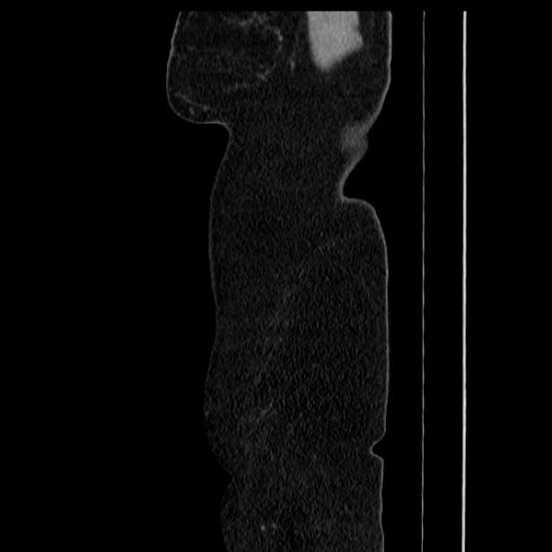 Acute pancreatitis - Balthazar C (Radiopaedia 26569-26714 Sagittal C+ portal venous phase 5).jpg
