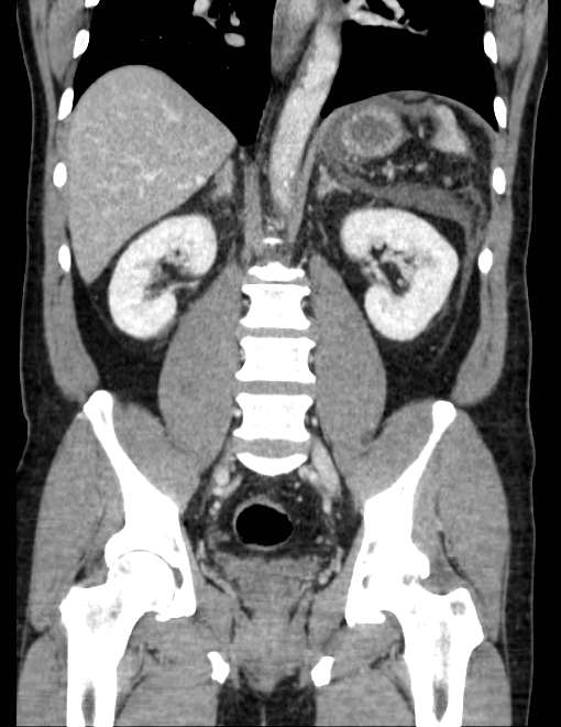 Acute pancreatitis - Balthazar E (Radiopaedia 23080-23110 Coronal C+ portal venous phase 51).jpg