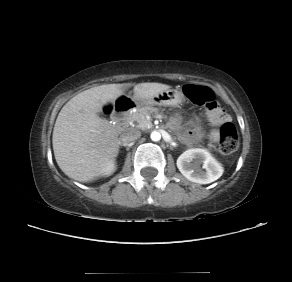 File:Acute pancreatitis - Balthazar E - post ERCP (Radiopaedia 27562-27772 Axial C+ arterial phase 20).png