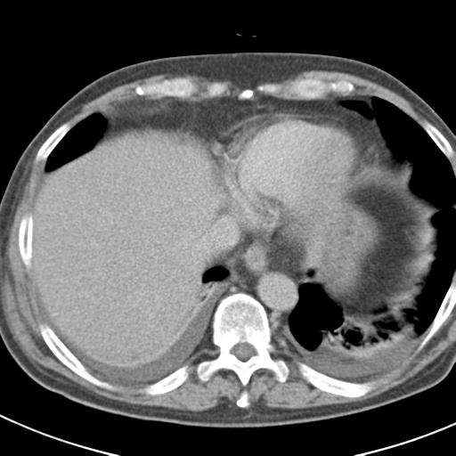 Acute pancreatitis and walled-off necrosis (Radiopaedia 29888-30403 Axial C+ delayed 12).jpg