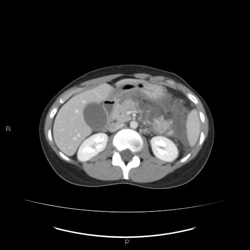 Acute pancreatitis secondary to stone at minor papilla and pancreatic divisum (Radiopaedia 76570-88333 Axial C+ portal venous phase 30).jpg