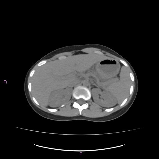 Acute pancreatitis secondary to stone at minor papilla and pancreatic divisum (Radiopaedia 76570-88333 Axial non-contrast 20).jpg
