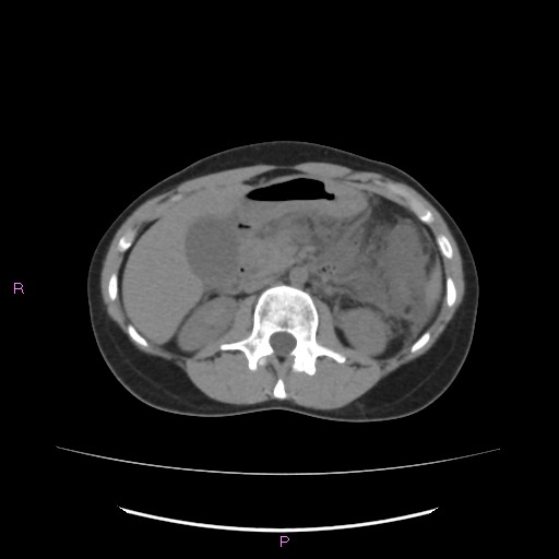 File:Acute pancreatitis secondary to stone at minor papilla and pancreatic divisum (Radiopaedia 76570-88333 Axial non-contrast 30).jpg