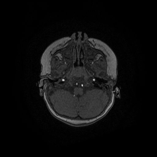 Acute phase of hemiconvulsion-hemiplegia epilepsy syndrome (Radiopaedia 29309-29745 Axial TOF angiography 130).jpg