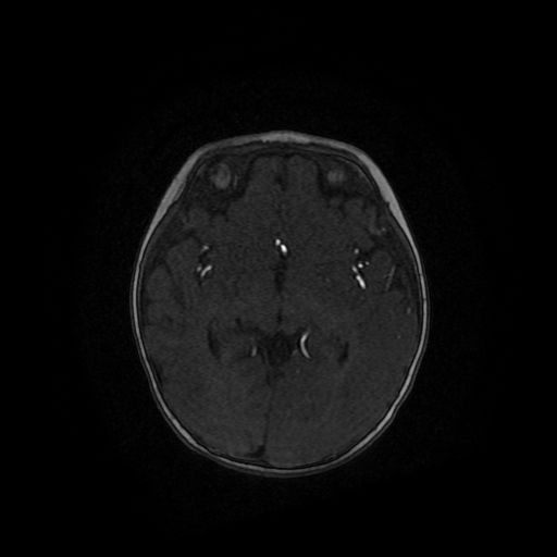 Acute phase of hemiconvulsion-hemiplegia epilepsy syndrome (Radiopaedia 29309-29745 Axial TOF angiography 66).jpg