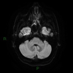 Acute posterior cerebral artery territory infarct (Radiopaedia 79329-92394 Axial DWI 8).jpg