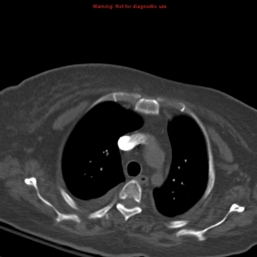 File:Acute pulmonary embolism (Radiopaedia 13286-13289 Axial C+ CTPA 18).jpg
