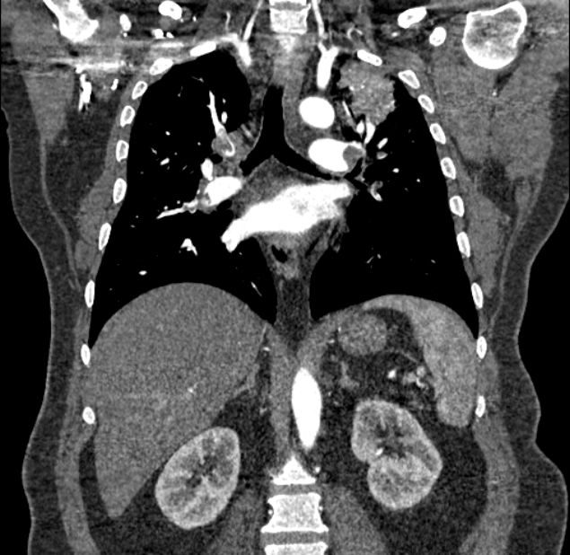 Acute pulmonary embolism with pulmonary infarcts (Radiopaedia 77688-89908 Coronal C+ CTPA 56).jpg