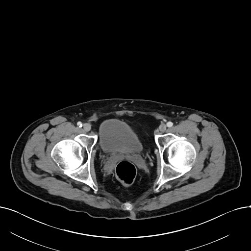 Acute renal infarction (Radiopaedia 59375-66736 Axial C+ portal venous phase 111).jpg