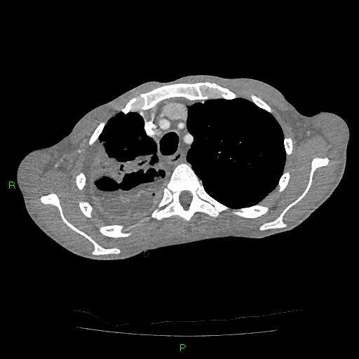 File:Acute right lung abscess (Radiopaedia 34806-36258 Axial C+ arterial phase 38).jpg