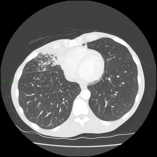 Acute right lung abscess (Radiopaedia 34806-36258 Axial lung window 135).jpg