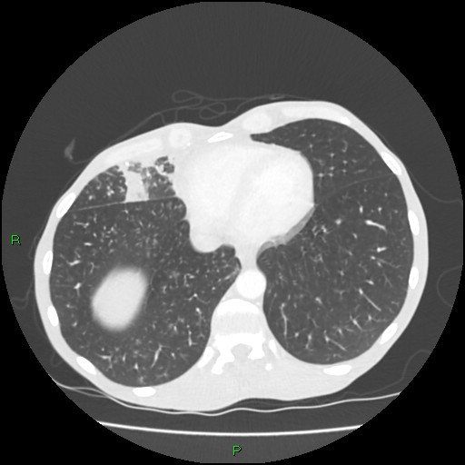 Acute right lung abscess (Radiopaedia 34806-36258 Axial lung window 145).jpg