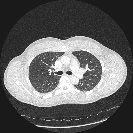 Acute segmental pulmonary emboli and pulmonary infarction (Radiopaedia 62264-70444 Axial lung window 68).jpg