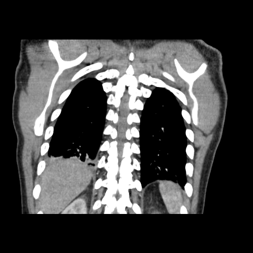 Acute segmental pulmonary emboli and pulmonary infarction (Radiopaedia 62264-70444 Coronal C+ CTPA 47).jpg