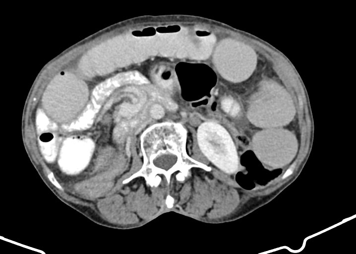 Acute small bowel (ileal) volvulus (Radiopaedia 71740-82139 Axial C+ portal venous phase 97).jpg