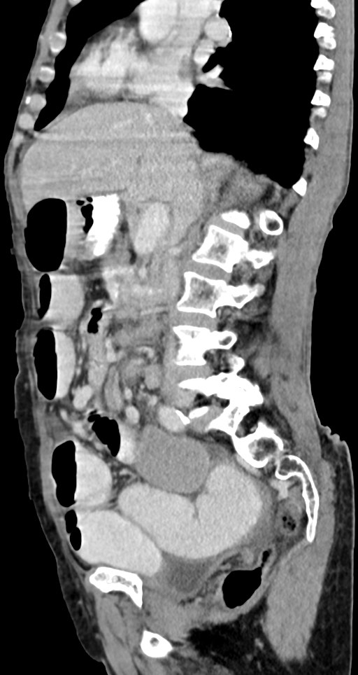 Acute small bowel (ileal) volvulus (Radiopaedia 71740-82139 Sagittal C+ portal venous phase 97).jpg