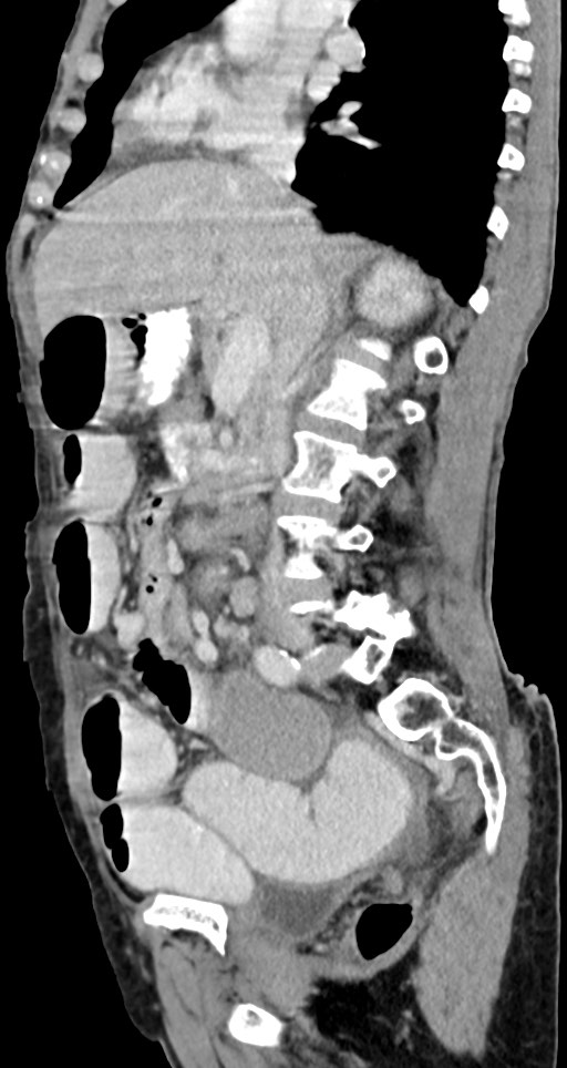 Acute small bowel (ileal) volvulus (Radiopaedia 71740-82139 Sagittal C+ portal venous phase 98).jpg
