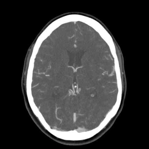 Acute subarachnoid hemorrhage and accessory anterior cerebral artery (Radiopaedia 69231-79009 D 37).jpg