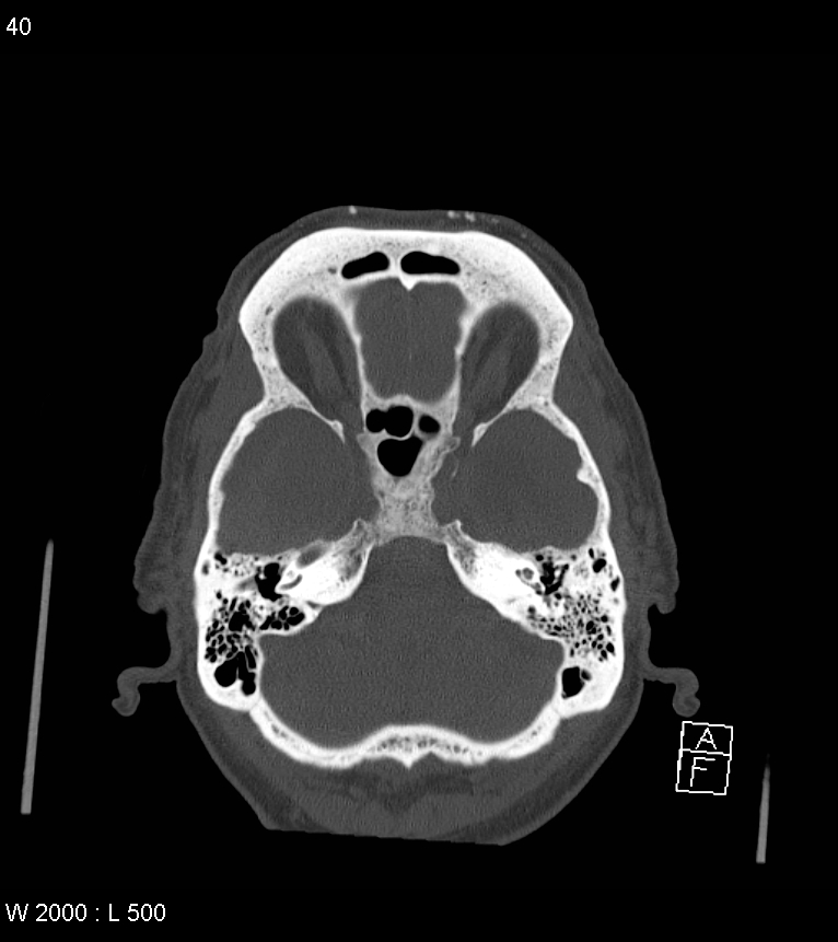 Acute subdural hematoma with myelofibrosis (Radiopaedia 52582-58494 Axial bone window 20).jpg