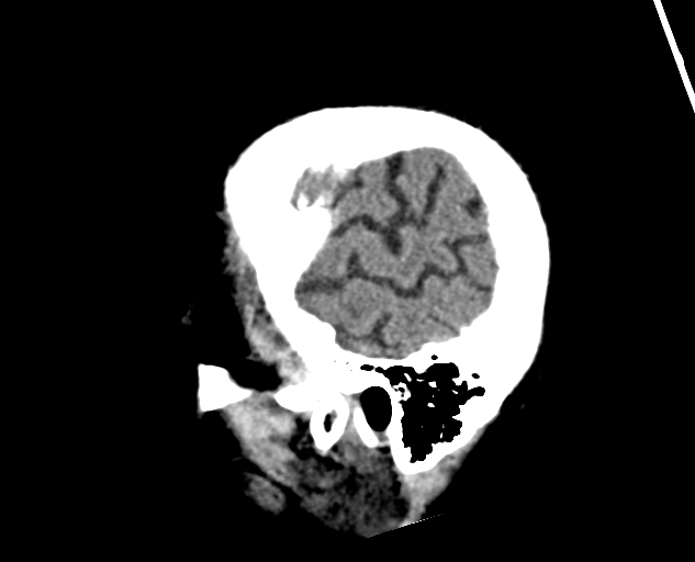 Acute traumatic subdural hematoma (Radiopaedia 82921-97257 Sagittal non-contrast 62).jpg