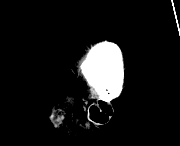 Acute traumatic subdural hematoma (Radiopaedia 82921-97257 Sagittal non-contrast 9).jpg