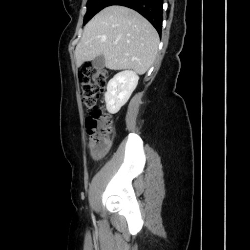 Acute uncomplicated appendicitis (Radiopaedia 73704-84499 Sagittal C+ portal venous phase 75).jpg