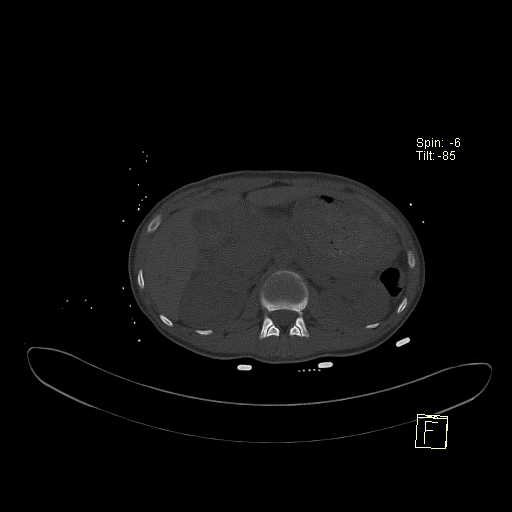 File:Acute vertebral compression fracture (Radiopaedia 63832-72559 Axial bone window 9).jpg