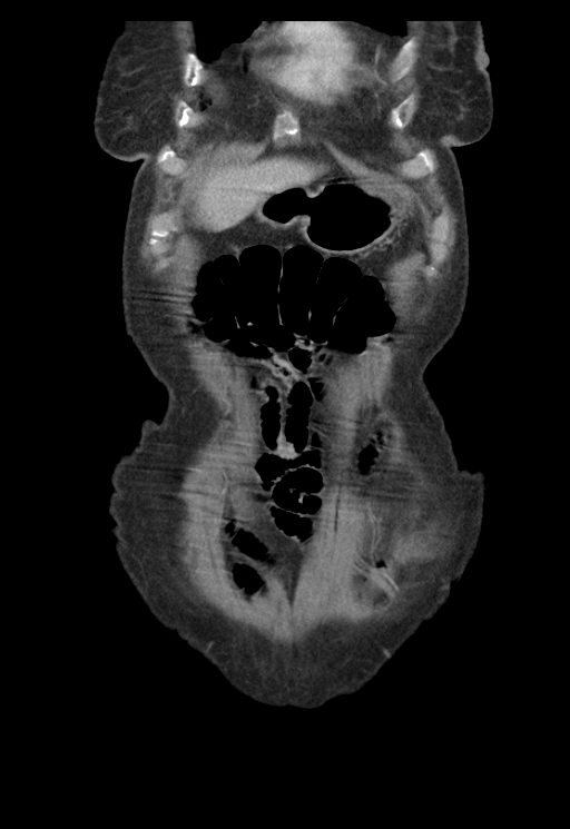 Adenocarcinoma of cecum (Radiopaedia 59222-66549 Coronal C+ portal venous phase 5).jpg