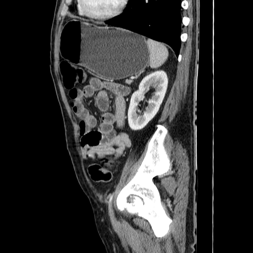 Adenocarcinoma of colon with entero-colic fistula (Radiopaedia 22832-22852 Sagittal C+ portal venous phase 47).jpg