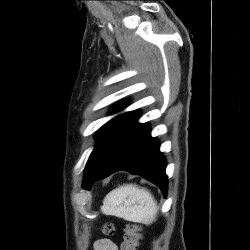Adenocarcinoma of the lung (Radiopaedia 59871-67325 Sagittal C+ arterial phase 94).jpg