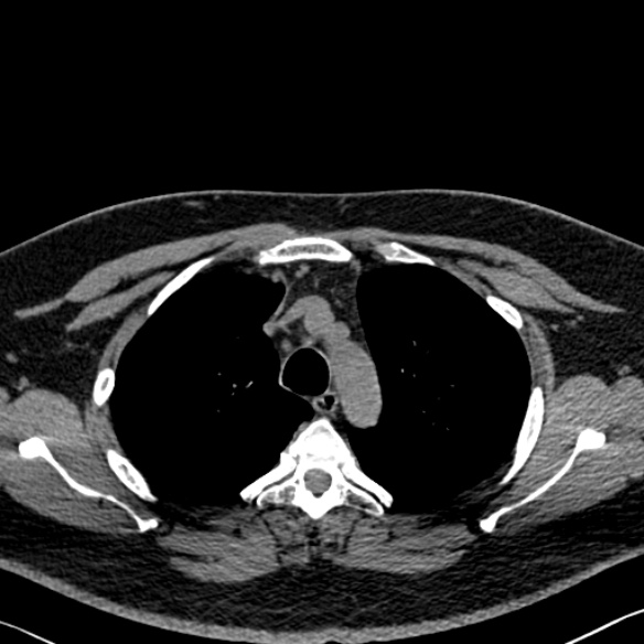 Adenoid cystic carcinoma of the trachea (Radiopaedia 49042-54137 Axial non-contrast 87).jpg
