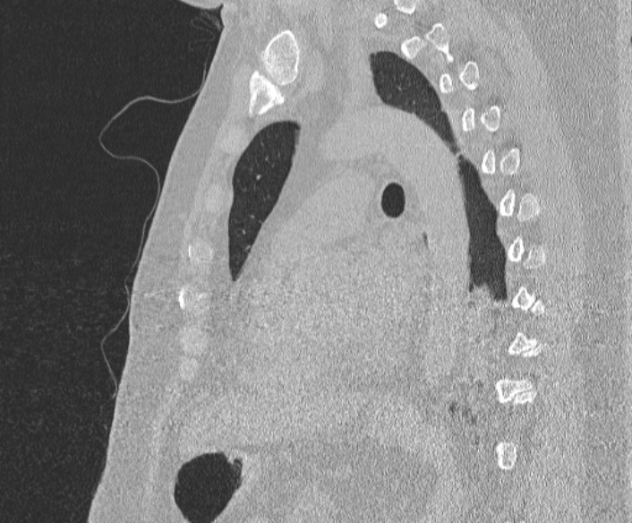 Adenoid cystic carcinoma of the trachea (Radiopaedia 49042-54137 Sagittal lung window 273).jpg