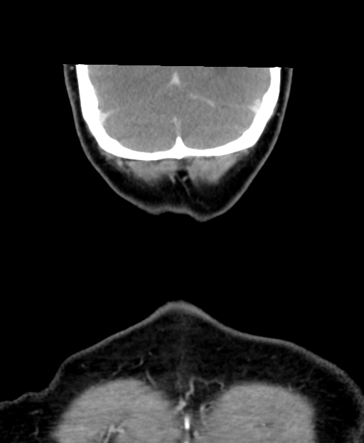 Adenoid cystic tumor of palate (Radiopaedia 46980-51518 Coronal C+ delayed 61).png