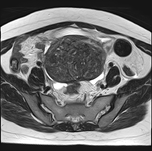 File:Adenomyosis - ovarian endometriomas (Radiopaedia 67031-76350 Axial T2 9).jpg