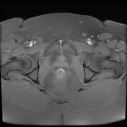 File:Adenomyosis within a didelphys uterus (Radiopaedia 70175-80215 Axial T1 fat sat 35).jpg