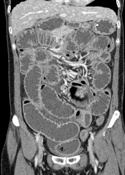 Adhesional small bowel obstruction (Radiopaedia 48397-53305 Coronal C+ portal venous phase 131).jpg
