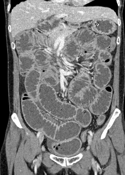 Adhesional small bowel obstruction (Radiopaedia 48397-53305 Coronal C+ portal venous phase 138).jpg