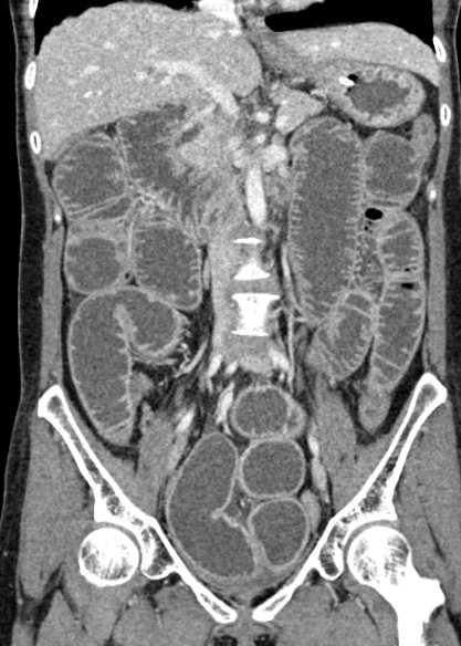 Adhesional small bowel obstruction (Radiopaedia 48397-53305 Coronal C+ portal venous phase 172).jpg