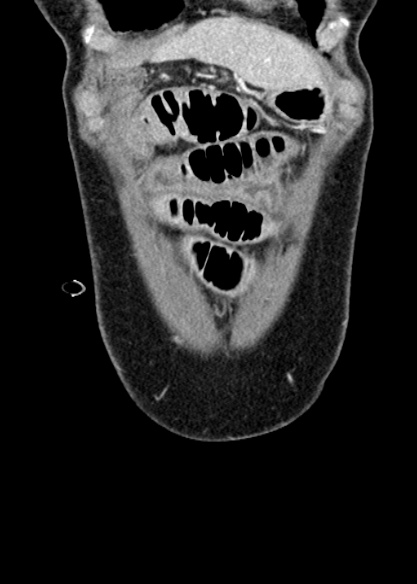 Adhesional small bowel obstruction (Radiopaedia 48397-53305 Coronal C+ portal venous phase 48).jpg